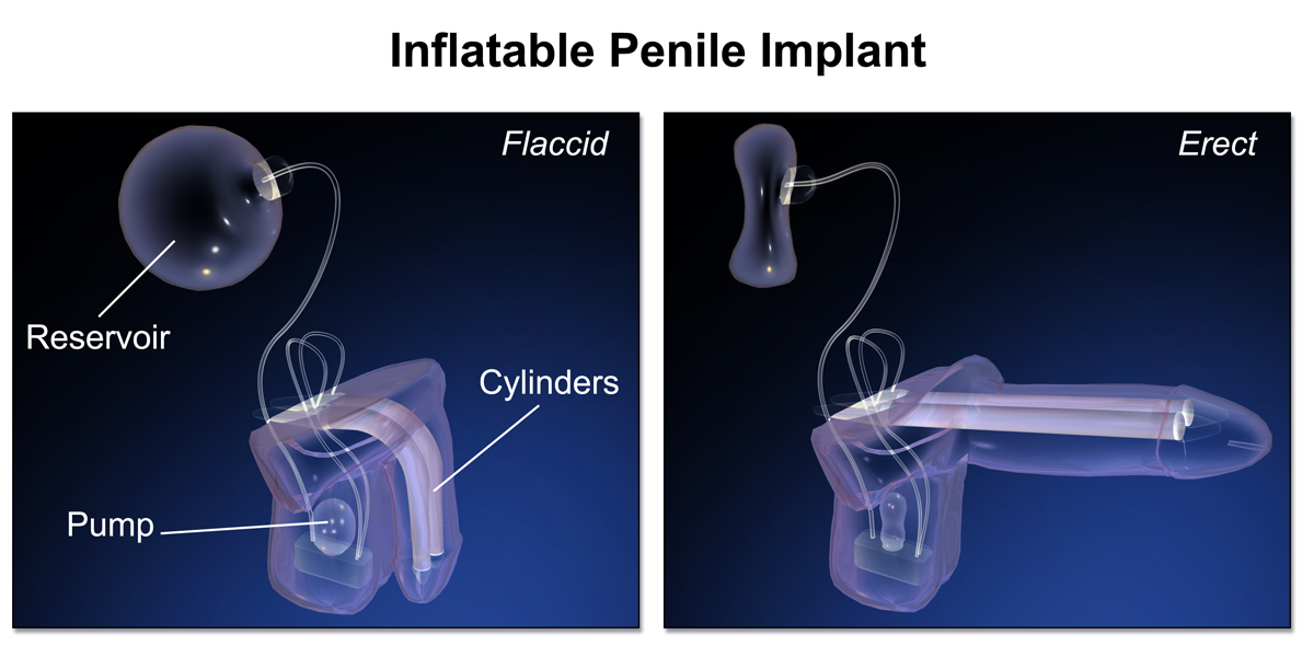 Penile Implant vs Injections: Which Treatment Are You Still Using in Five Years?