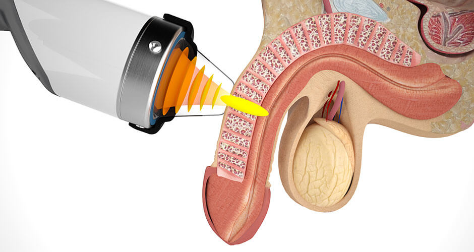 Shockwave Therapy in Turkey: What the Evidence Says Before You Book