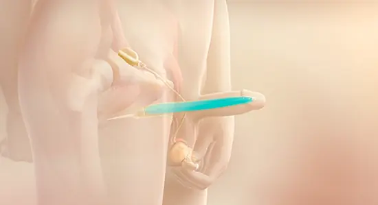Titan® Inflatable Penile Implant