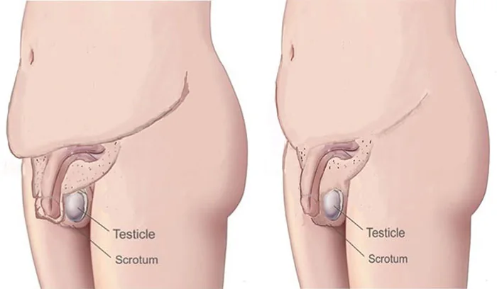 Wound healing and complication risks after buried penis reconstruction
