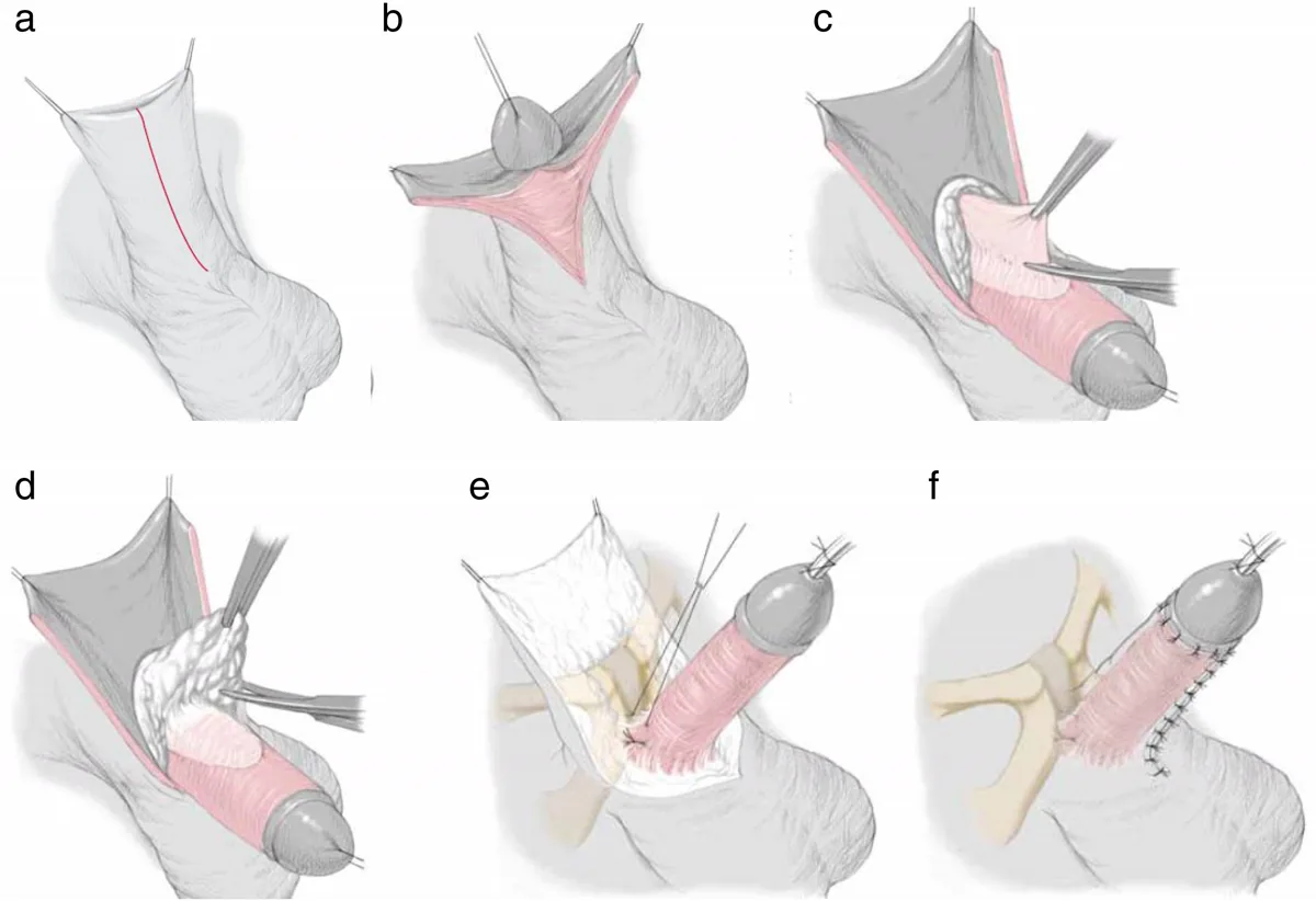 Adult acquired buried penis, where the shaft is concealed by the surrounding suprapubic tissue