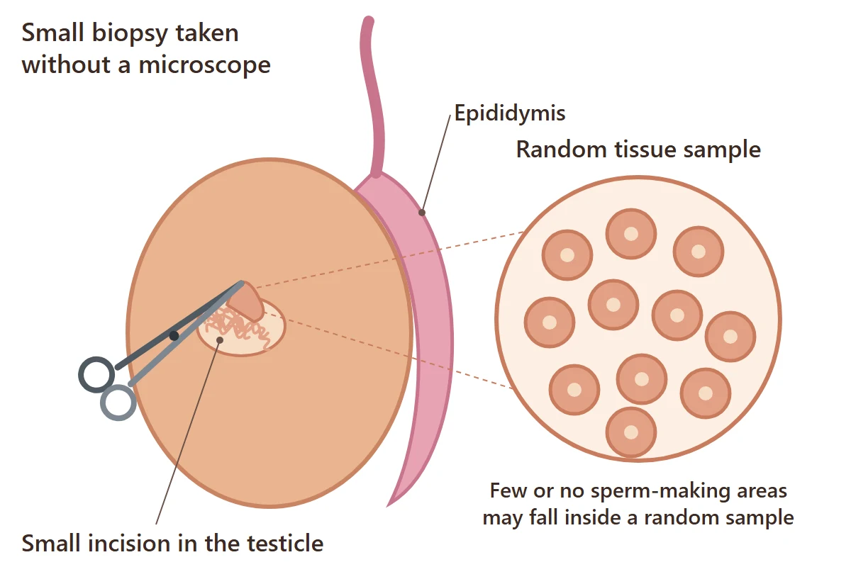 Conventional TESE diagram: a small random biopsy taken from the testicle without a microscope