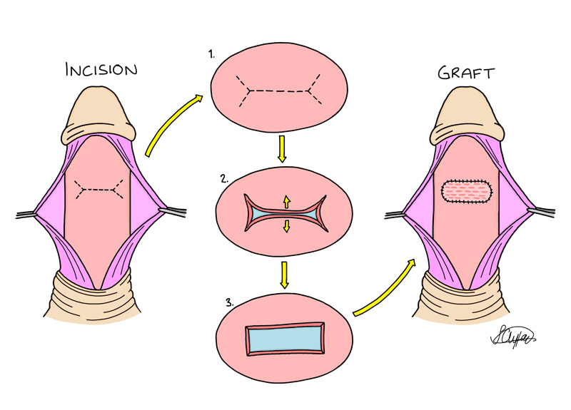 Plaque incision and grafting Lue procedure