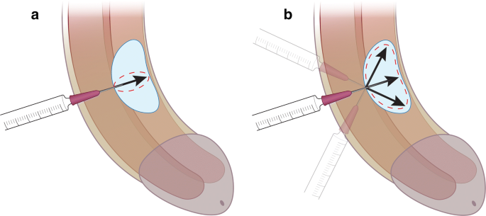 Non-surgical treatments for Peyronie's disease