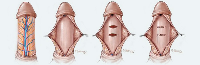 Penile plication for curvature correction