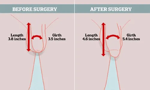 Penile girth enhancement Turkey