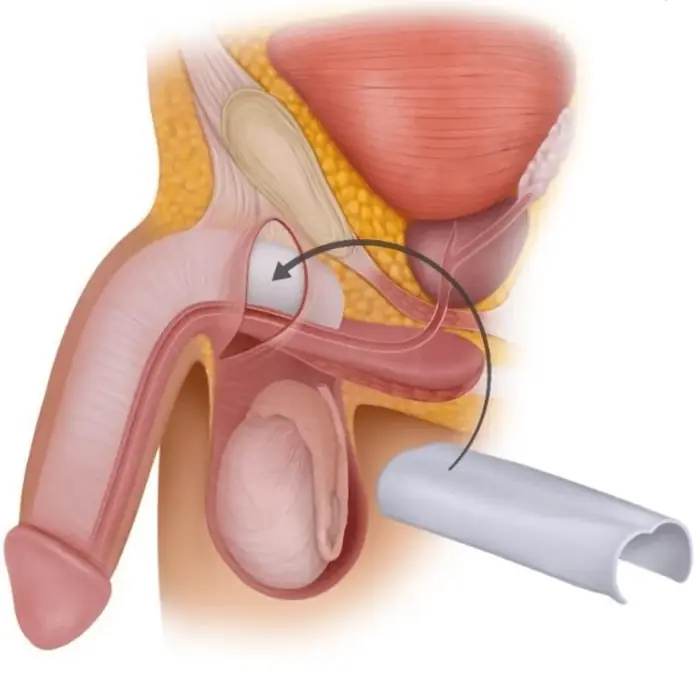 Silicone penile girth implant Himplant