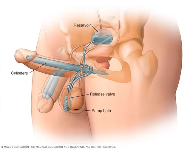 Three-piece inflatable penile implant