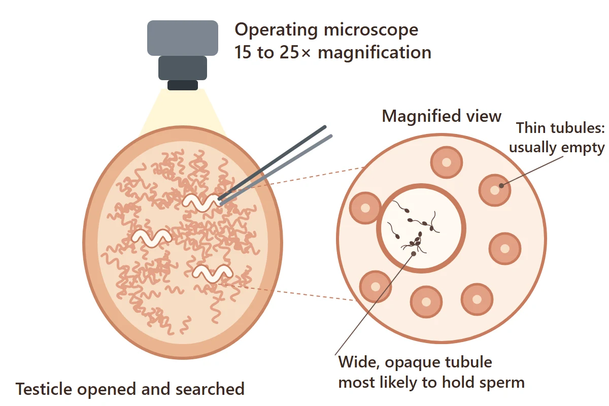 Micro-TESE diagram: the opened testicle under an operating microscope, with a wide tubule holding sperm beside thin empty tubules