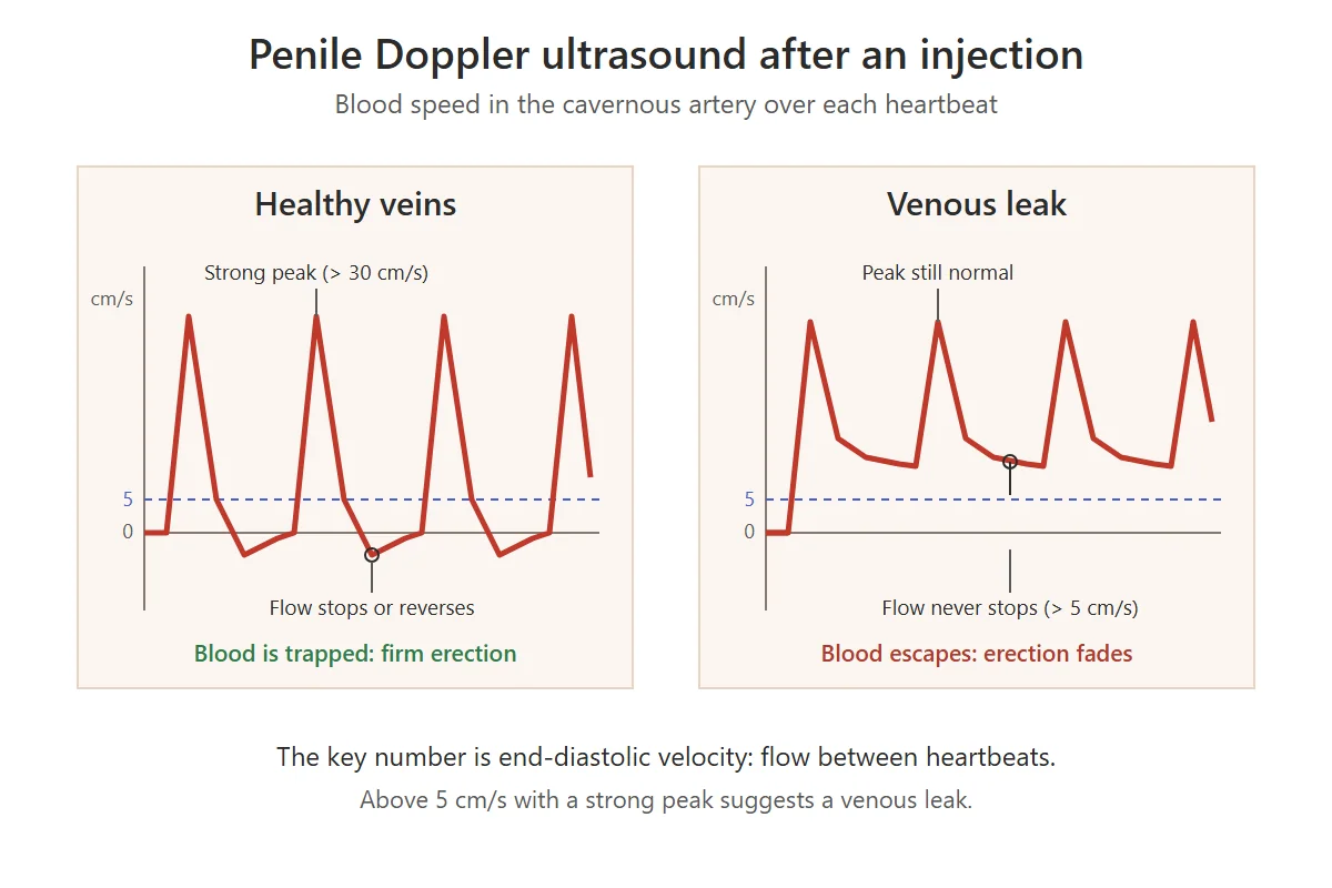 Penile Doppler ultrasound waveforms: in healthy veins flow stops between heartbeats, in a venous leak it stays above 5 cm/s