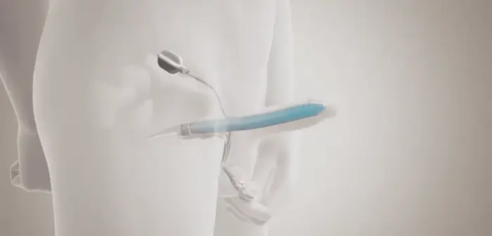 Types of penile implants