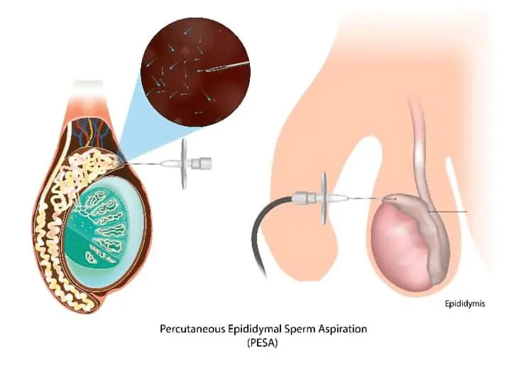Surgical sperm retrieval options: TESE, micro-TESE and MESA