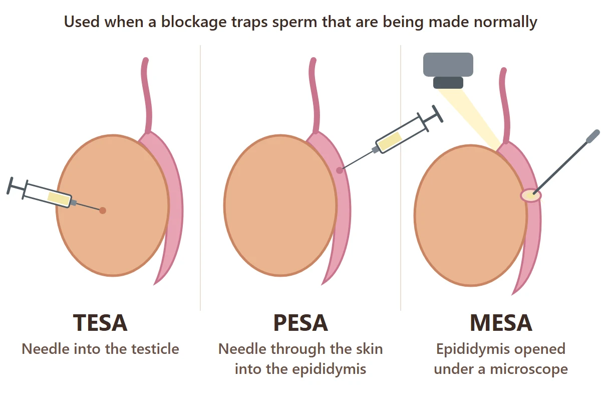 TESA, PESA and MESA diagram: a needle into the testicle, a needle into the epididymis, and the epididymis opened under a microscope