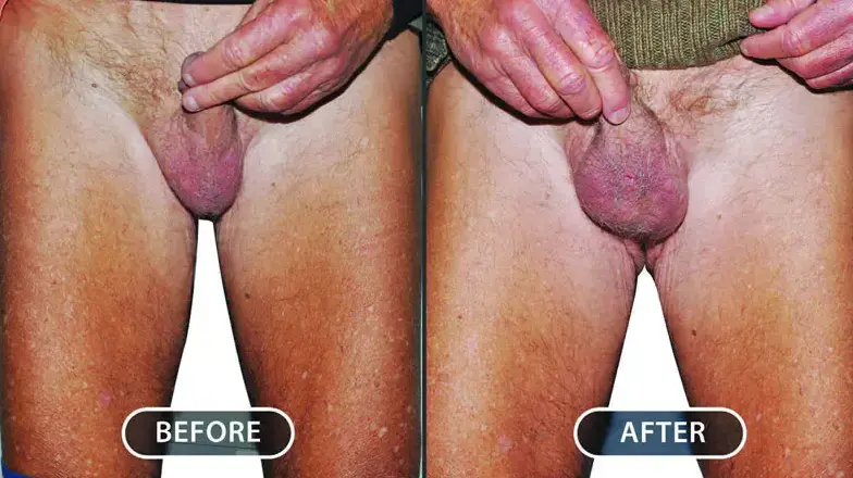 Before and after a testicular implant: the empty side on the left, the restored scrotal shape on the right