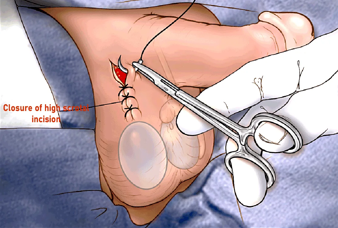 Surgical illustration of a testicular implant seated in the scrotum, with the high scrotal incision being closed