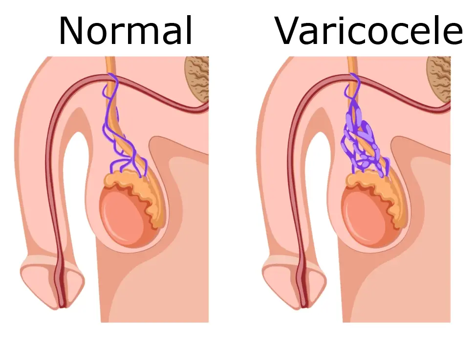 Microsurgical varicocele repair